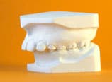 Distalbiss Normalbehandlung Anfangsabdruck (Vorher)