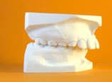 Distalbiss Normalbehandlung Anfangsabdruck (Vorher)