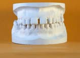 Bialveoläre Protrusion Anfangsabdruck (Vorher)