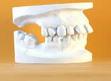 Bialveoläre Protrusion Anfangsabdruck (Vorher)