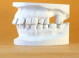 Bialveoläre Protrusion Anfangsabdruck (Vorher)