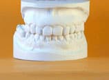 Bialveoläre Protrusion Schlussabdruck (Nachher)