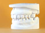 Bialveoläre Protrusion Schlussabdruck (Nachher)
