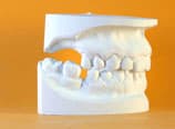 Bialveoläre Protrusion Schlussabdruck (Nachher)